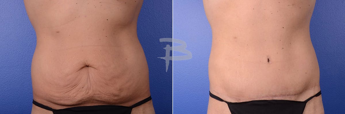 Abdominoplasty Before & After Gallery - Patient 192278122 - Image 1