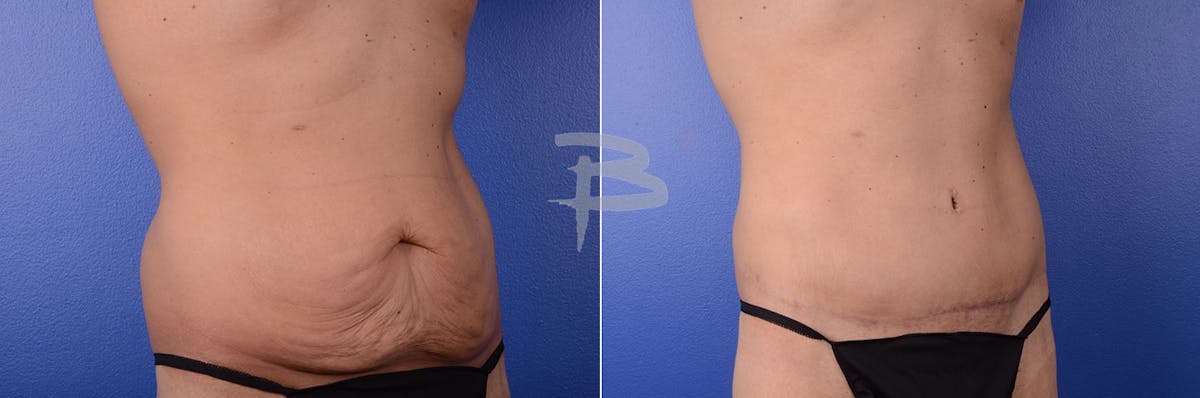 Abdominoplasty Before & After Gallery - Patient 192278123 - Image 1