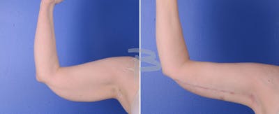Brachioplasty Before & After Gallery - Patient 192278145 - Image 1