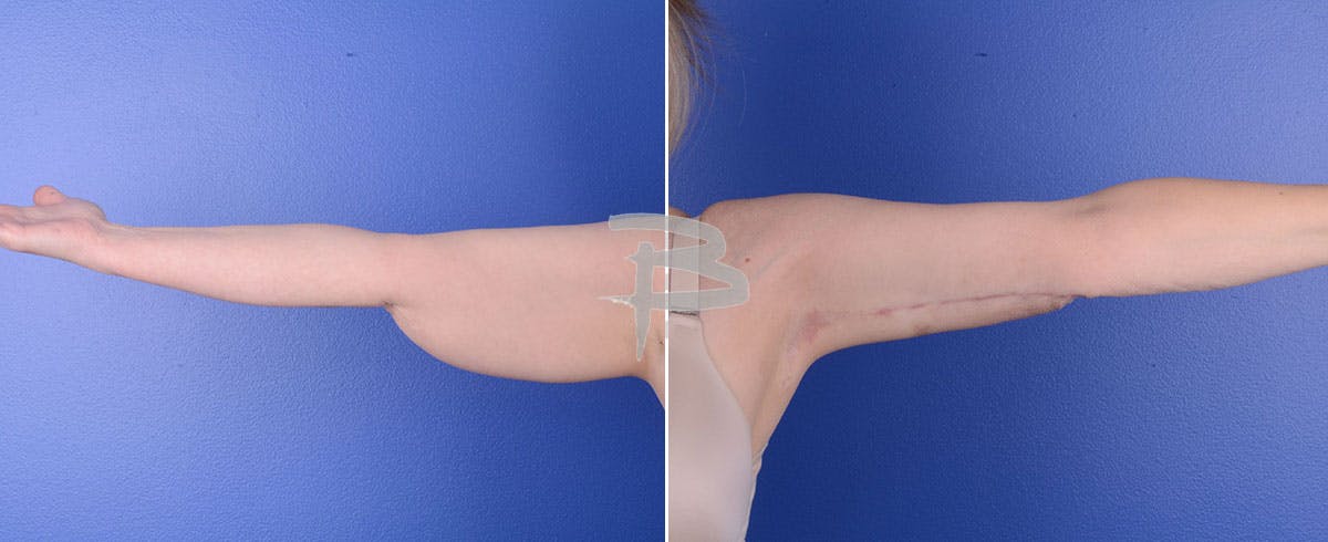 Brachioplasty Before & After Gallery - Patient 192278151 - Image 1