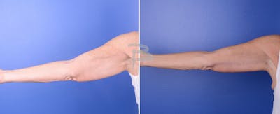 Brachioplasty Before & After Gallery - Patient 192278156 - Image 1