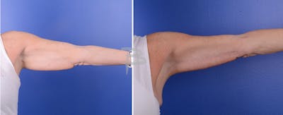Brachioplasty Before & After Gallery - Patient 192278160 - Image 1