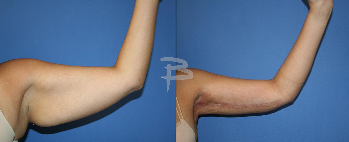 Brachioplasty Before & After Gallery - Patient 192278161 - Image 1