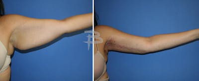 Brachioplasty Before & After Gallery - Patient 192278162 - Image 1