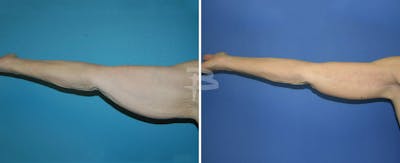 Brachioplasty Before & After Gallery - Patient 192278164 - Image 1