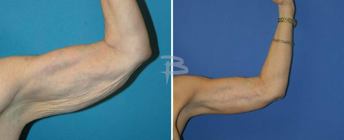Brachioplasty Before & After Gallery - Patient 192278166 - Image 1