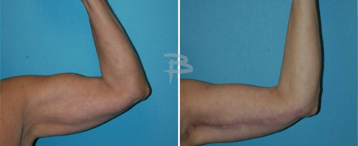 Brachioplasty Before & After Gallery - Patient 192278167 - Image 1
