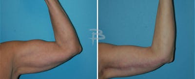 Brachioplasty Before & After Gallery - Patient 192278167 - Image 1