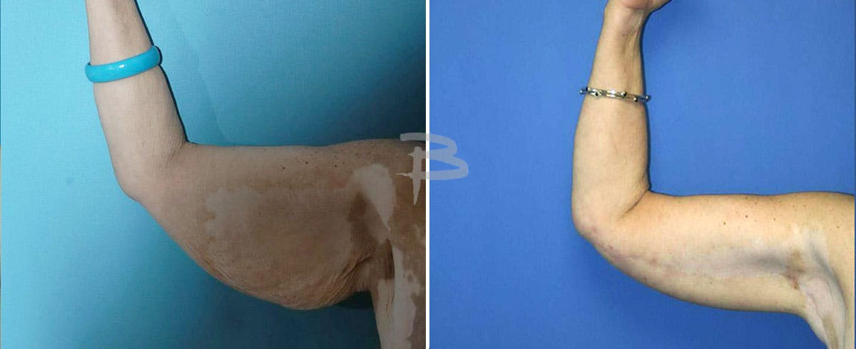 Brachioplasty Before & After Gallery - Patient 192278174 - Image 1