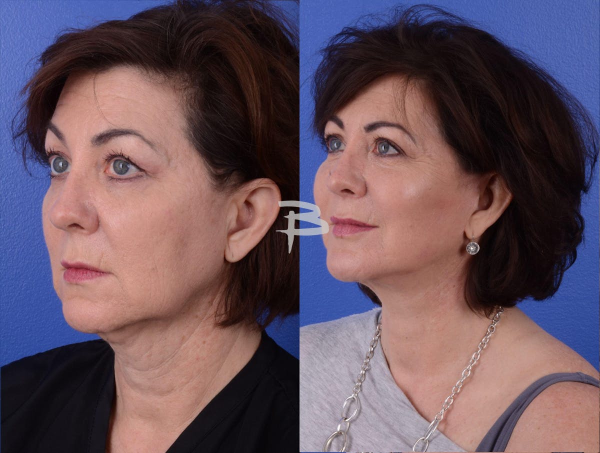 Facelift Before & After Gallery - Patient 984341 - Image 2