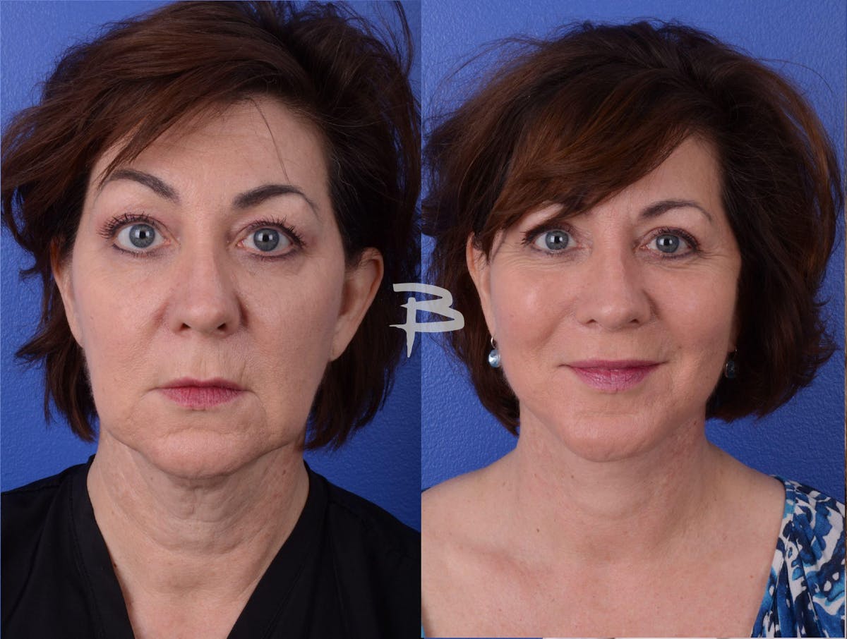 Facelift Before & After Gallery - Patient 984341 - Image 1