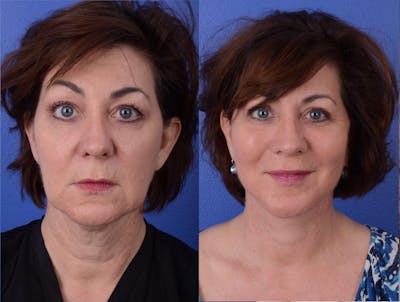 Facelift Before & After Gallery - Patient 984341 - Image 1