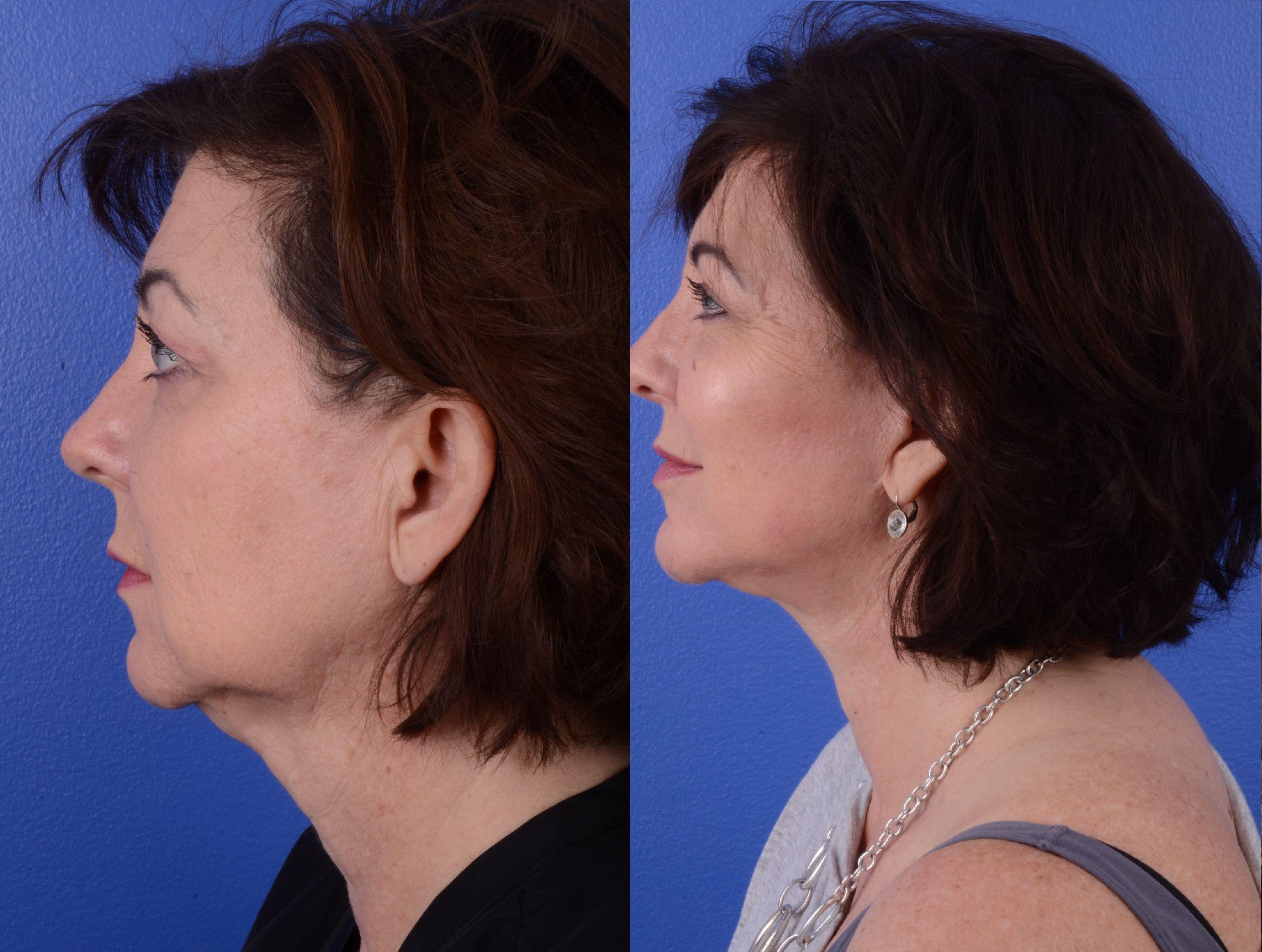 Facelift Before & After Gallery - Patient 984341 - Image 3