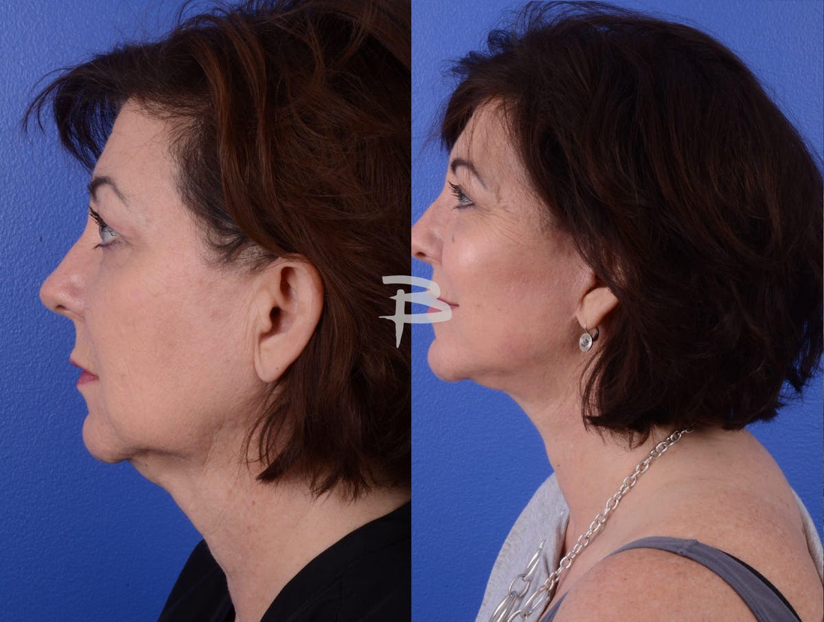 Facelift Before & After Gallery - Patient 984341 - Image 3