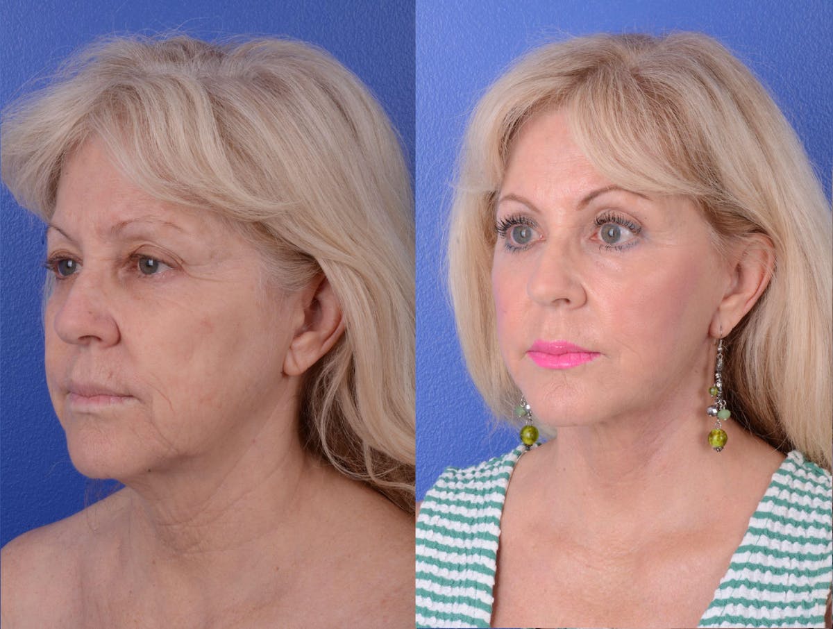 Facelift Before & After Gallery - Patient 372078 - Image 2