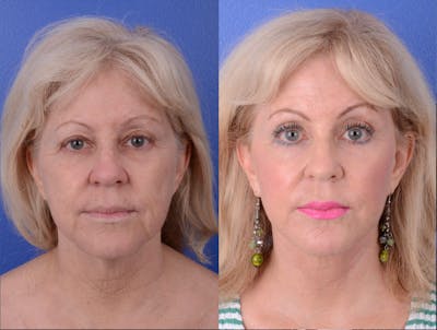 Facelift Before & After Gallery - Patient 372078 - Image 1