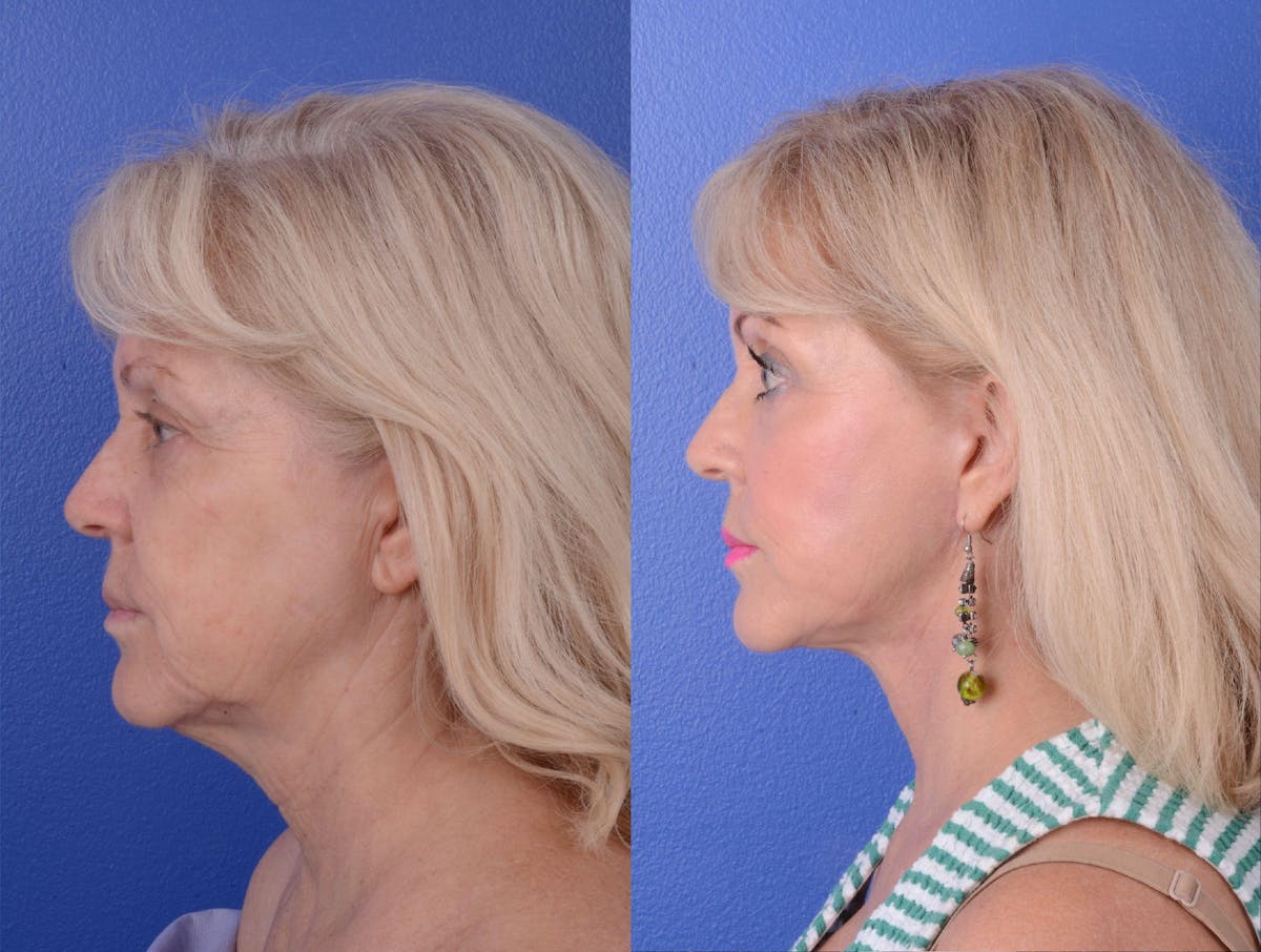 Facelift Before & After Gallery - Patient 372078 - Image 3