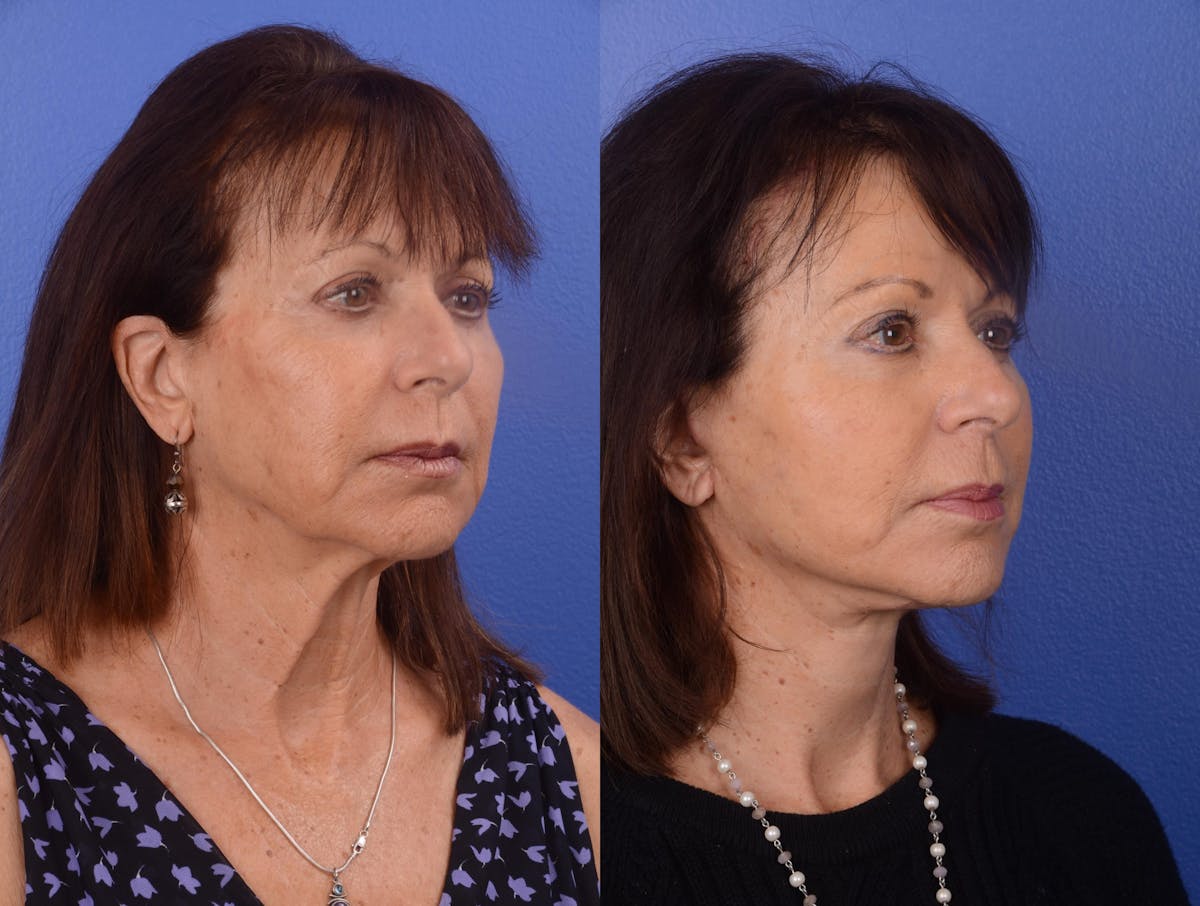 Facelift Before & After Gallery - Patient 270080 - Image 2