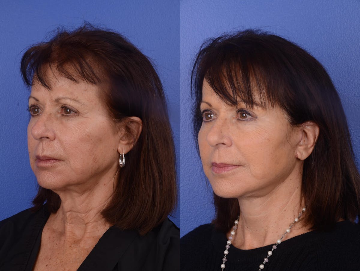 Facelift Before & After Gallery - Patient 270080 - Image 3