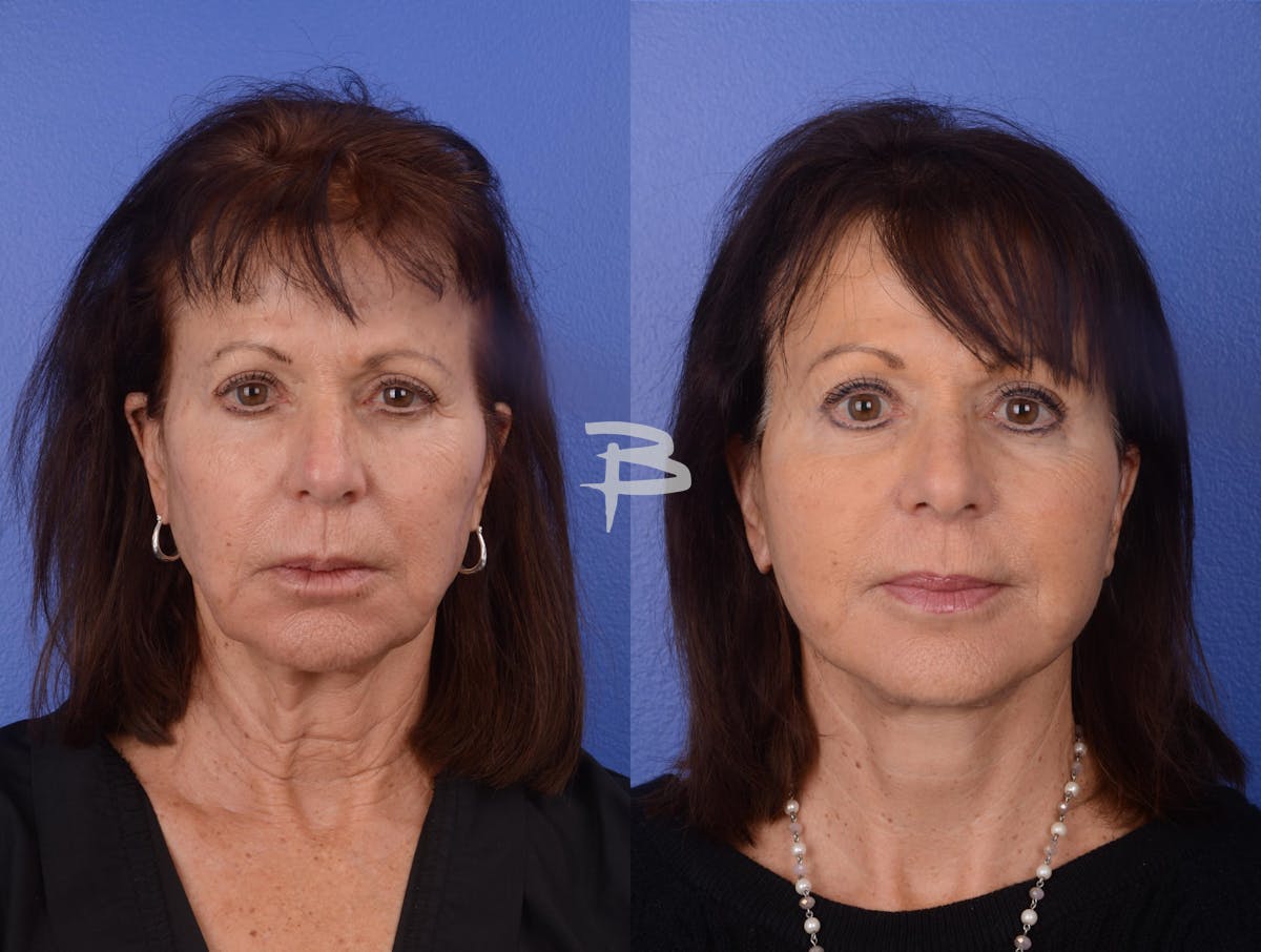 Facelift Before & After Gallery - Patient 270080 - Image 1