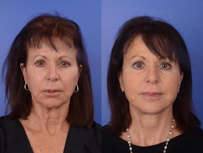 Facelift Before & After Gallery - Patient 270080 - Image 1