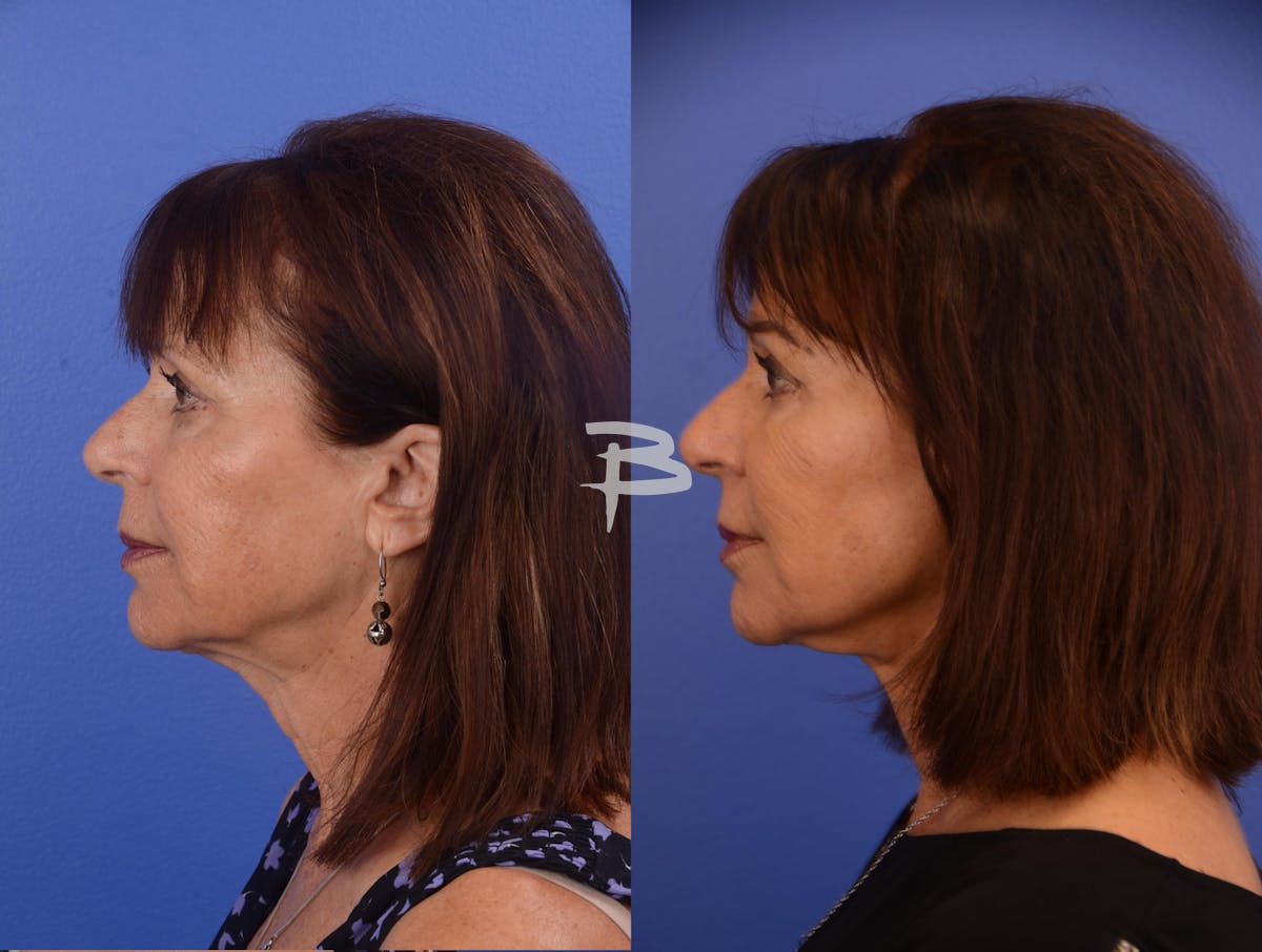 Facelift Before & After Gallery - Patient 270080 - Image 3