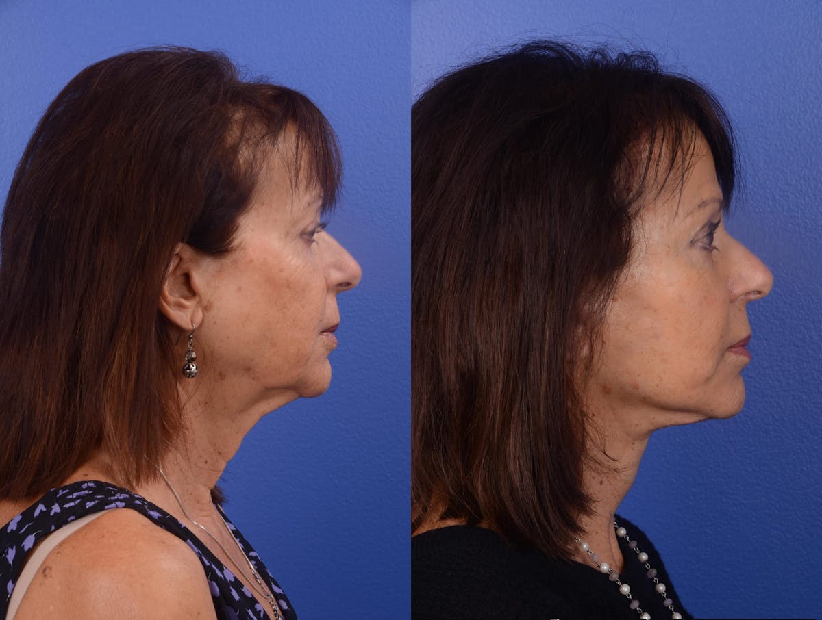 Facelift Before & After Gallery - Patient 270080 - Image 5