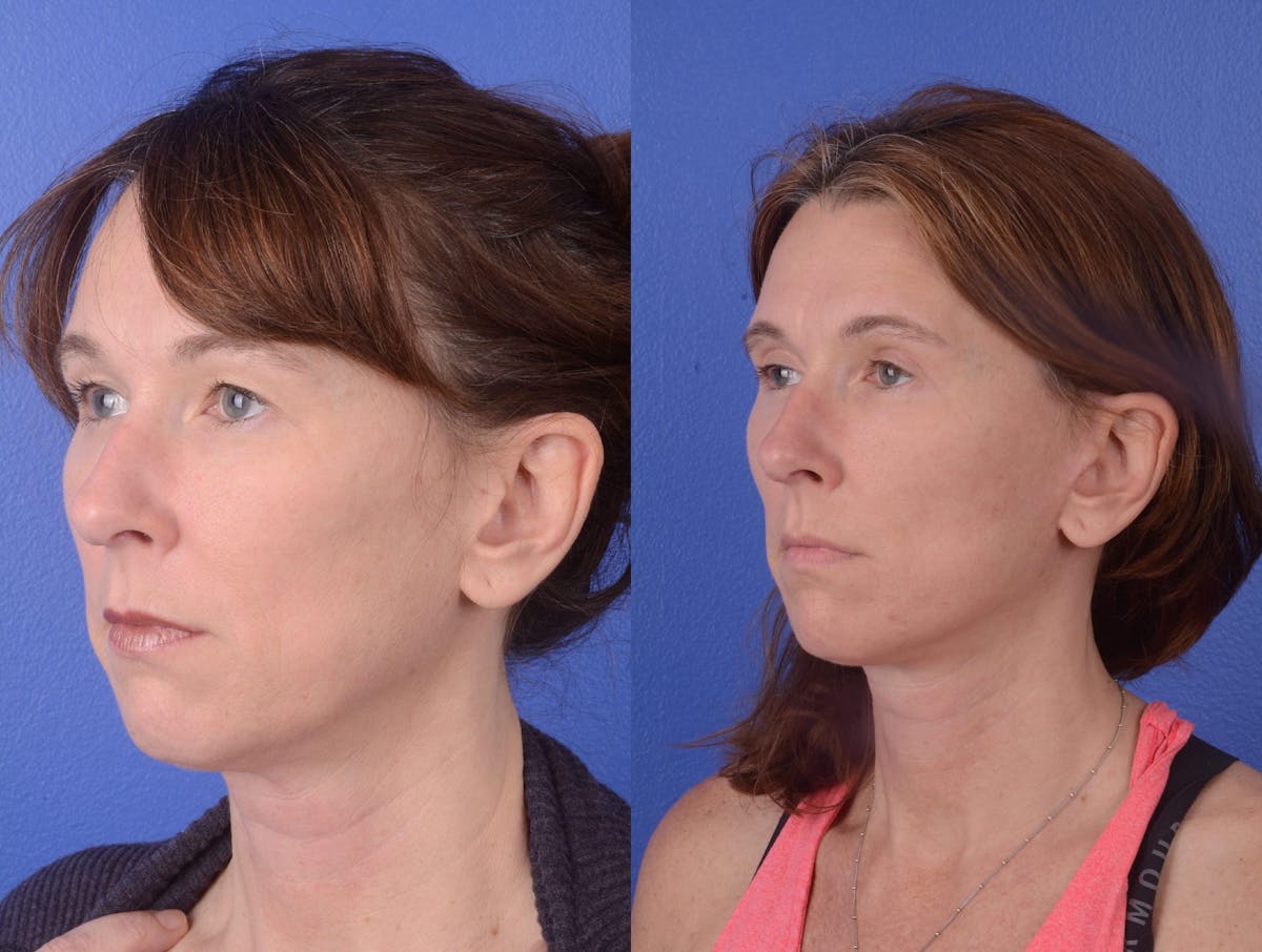 Facelift Before & After Gallery - Patient 901543 - Image 2