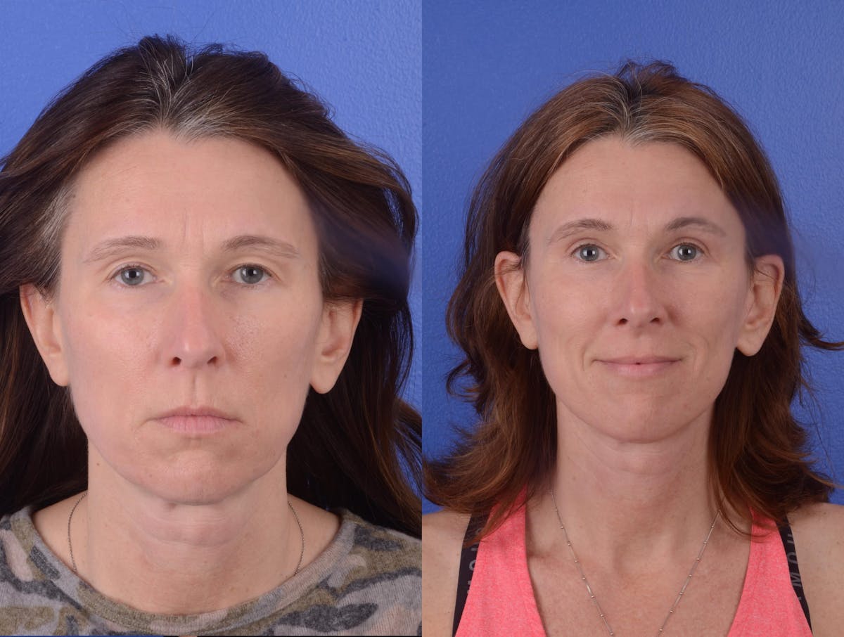 Facelift Before & After Gallery - Patient 901543 - Image 1