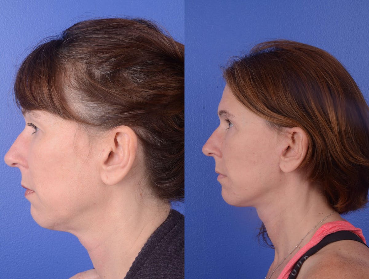 Facelift Before & After Gallery - Patient 901543 - Image 3