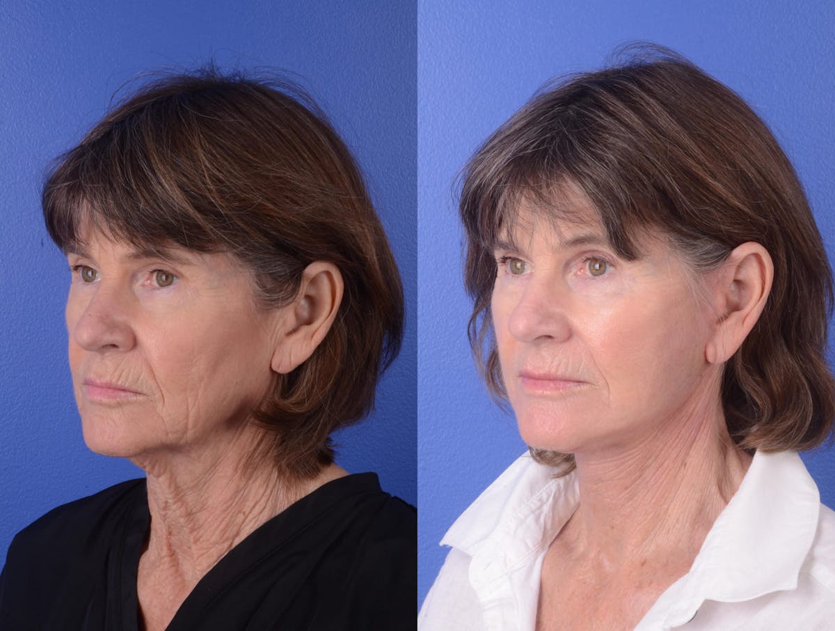 Facelift Before & After Gallery - Patient 133444 - Image 2