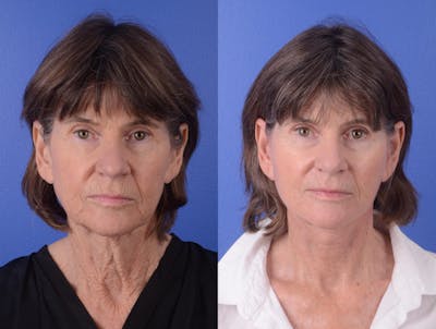 Facelift Before & After Gallery - Patient 133444 - Image 1