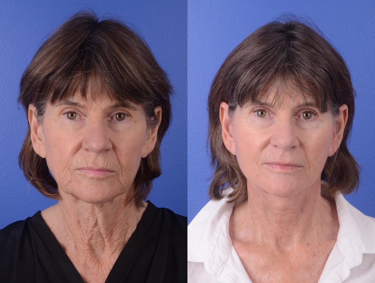 Facelift Before & After Gallery - Patient 133444 - Image 1