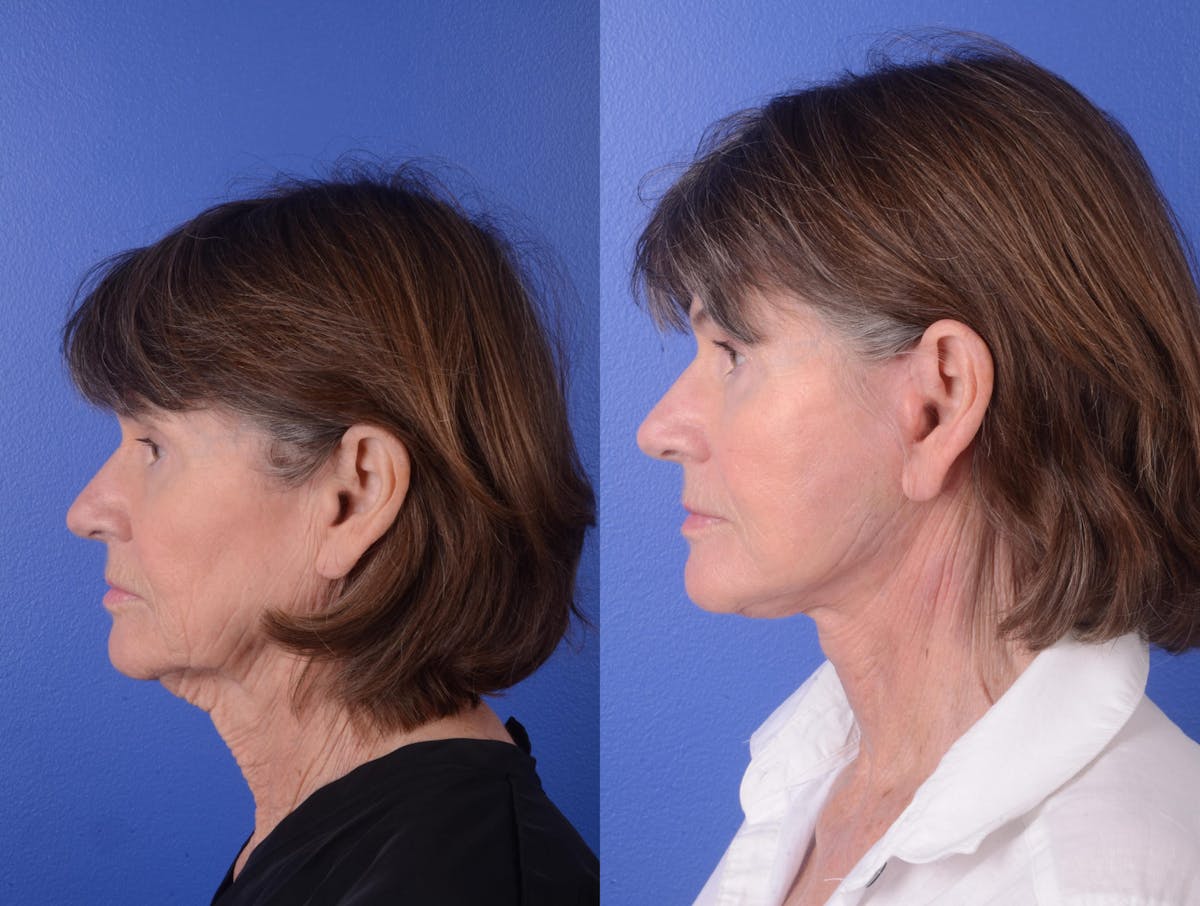Facelift Before & After Gallery - Patient 133444 - Image 3