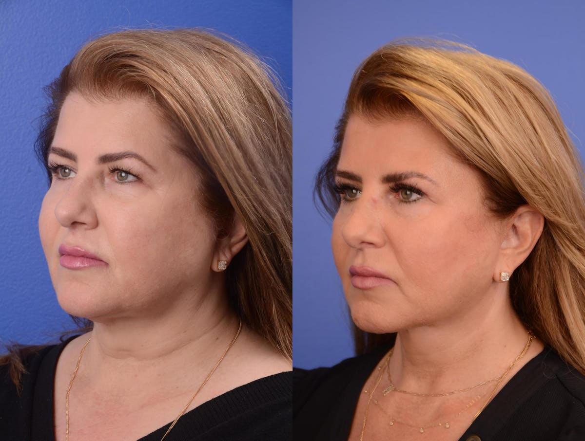 Facelift Before & After Gallery - Patient 200295 - Image 2