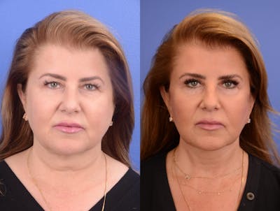 Facelift Before & After Gallery - Patient 200295 - Image 1
