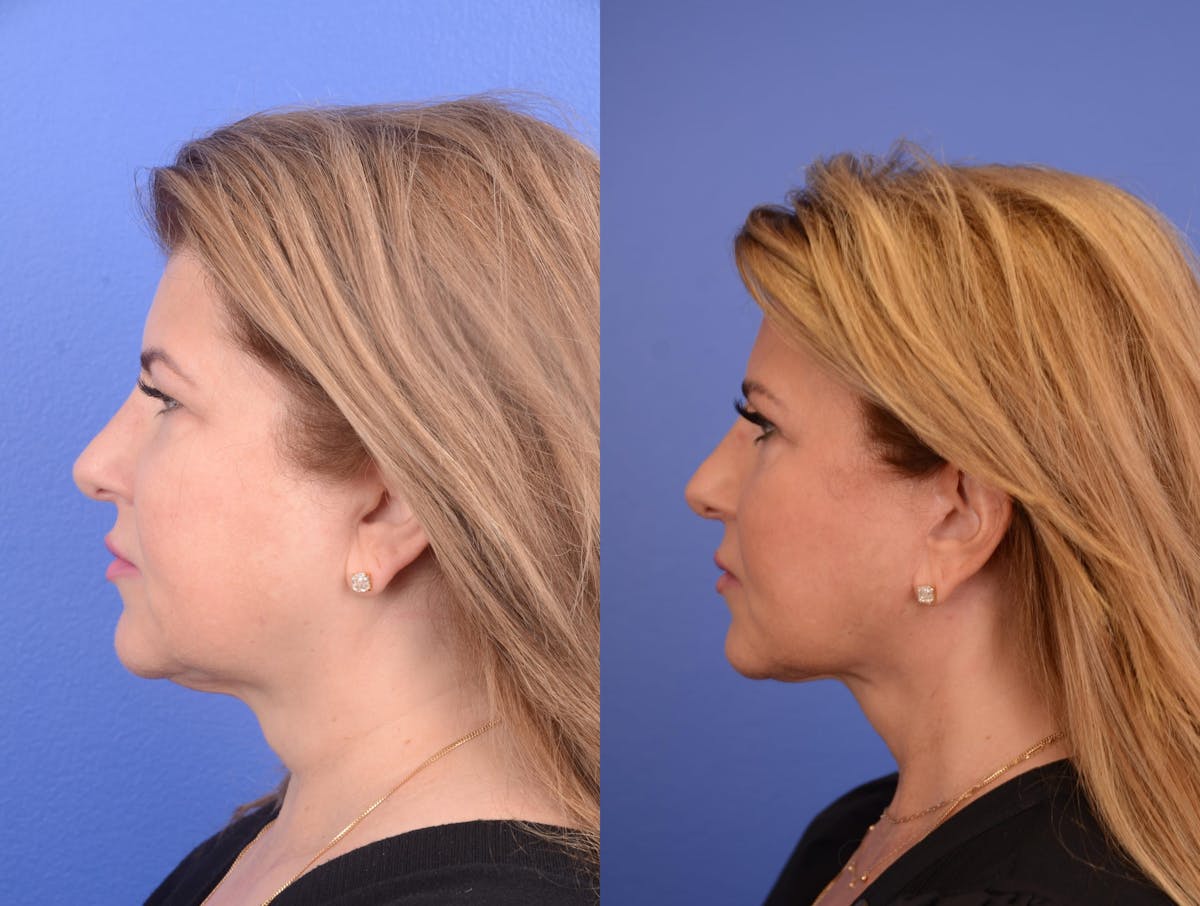 Facelift Before & After Gallery - Patient 200295 - Image 3