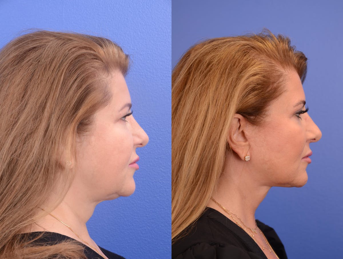 Facelift Before & After Gallery - Patient 200295 - Image 4