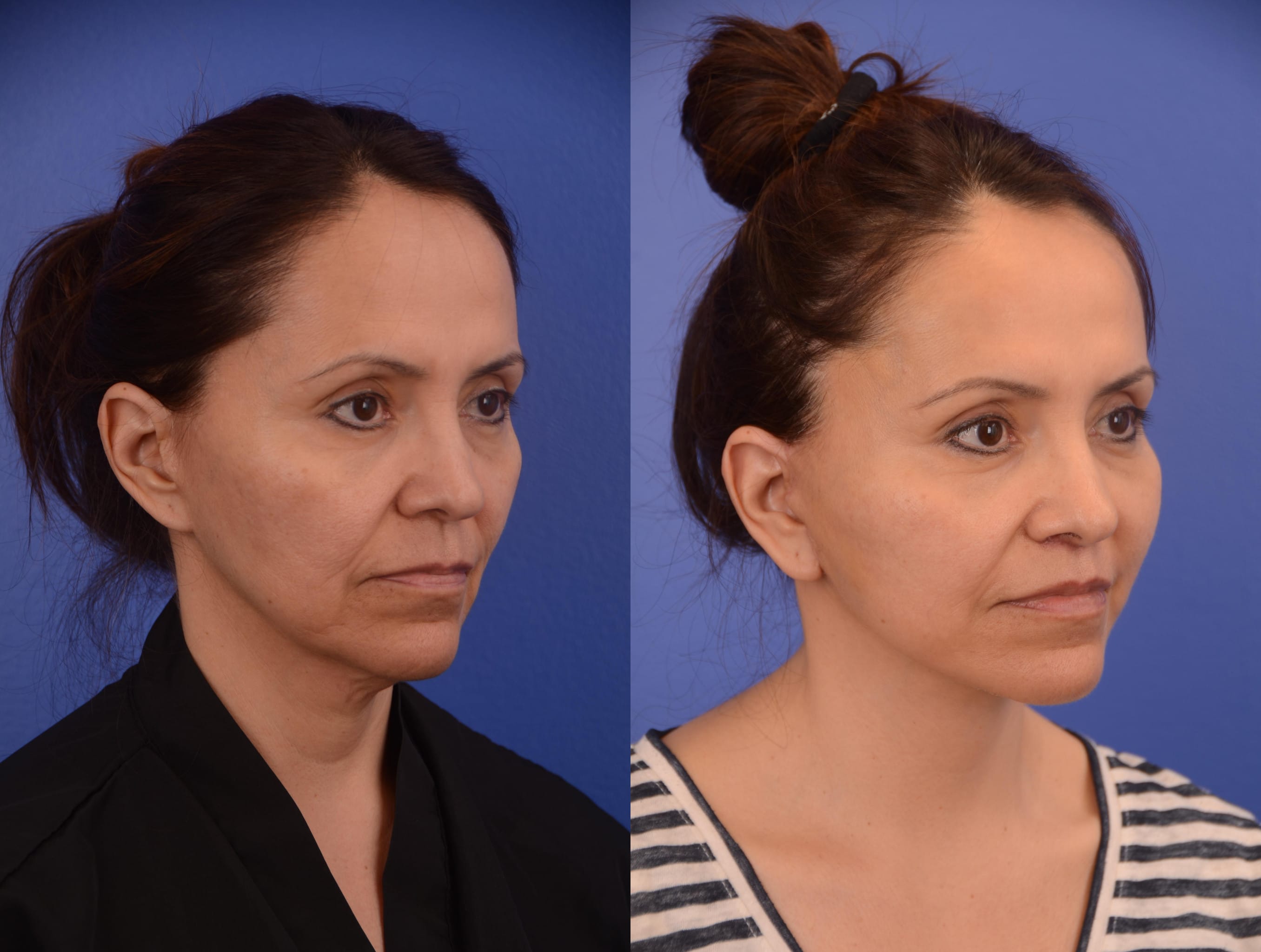 Facelift Before & After Gallery - Patient 278796 - Image 2