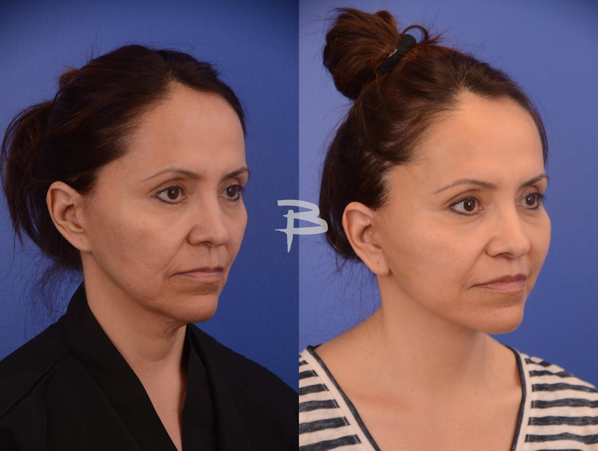 Facelift Before & After Gallery - Patient 278796 - Image 2