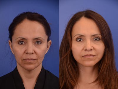 Facelift Before & After Gallery - Patient 278796 - Image 1