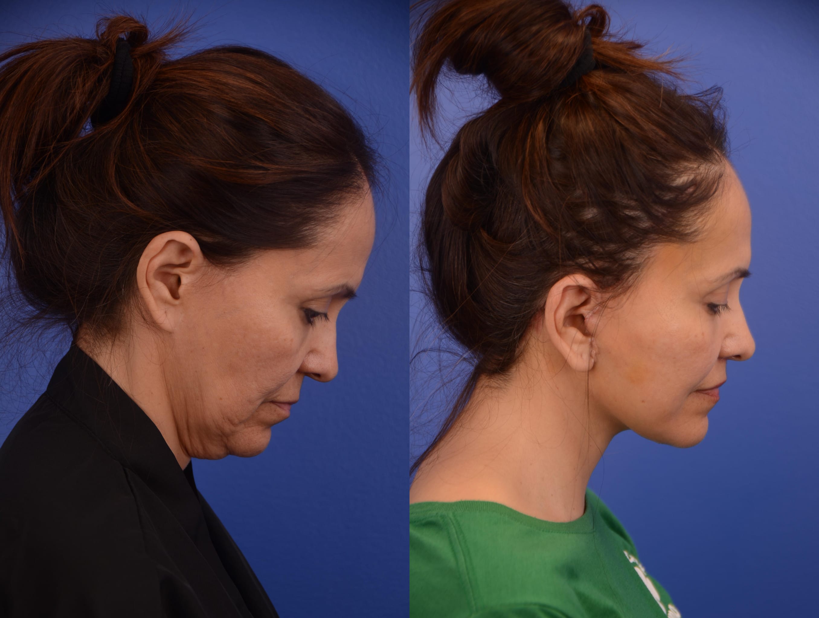 Facelift Before & After Gallery - Patient 278796 - Image 3