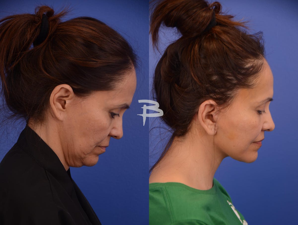 Facelift Before & After Gallery - Patient 278796 - Image 3