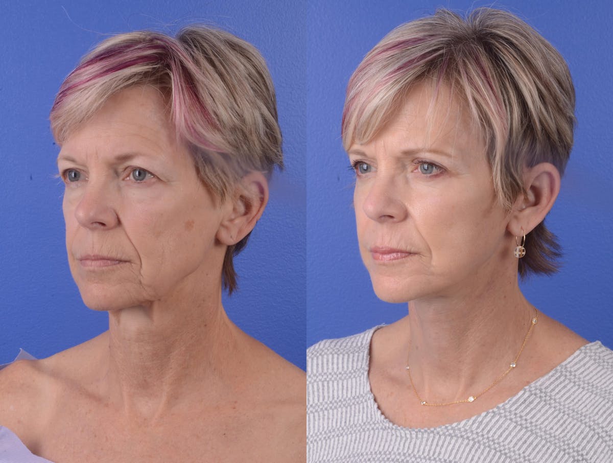 Facelift Before & After Gallery - Patient 272572 - Image 2