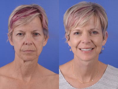 Facelift Before & After Gallery - Patient 272572 - Image 1