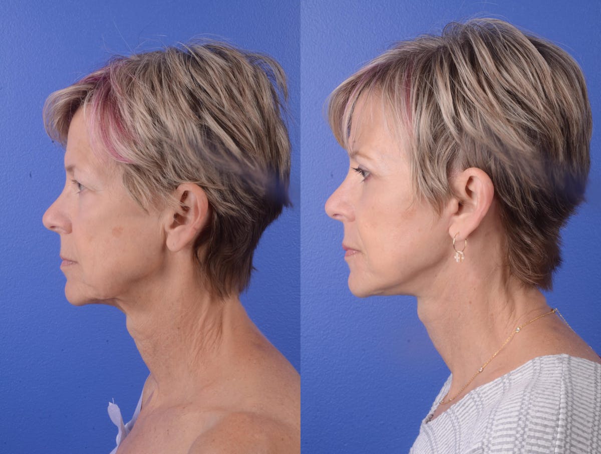 Facelift Before & After Gallery - Patient 272572 - Image 3