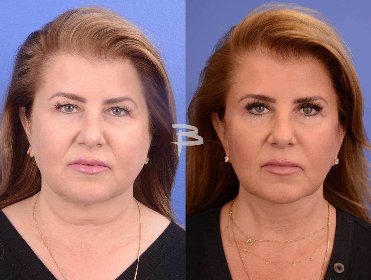 Buccal Fat Removal Before & After Gallery - Patient 202278 - Image 1