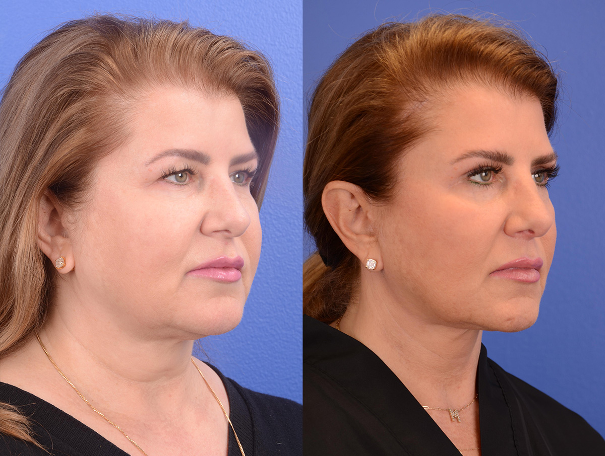 Buccal Fat Removal Before & After Gallery - Patient 202278 - Image 2