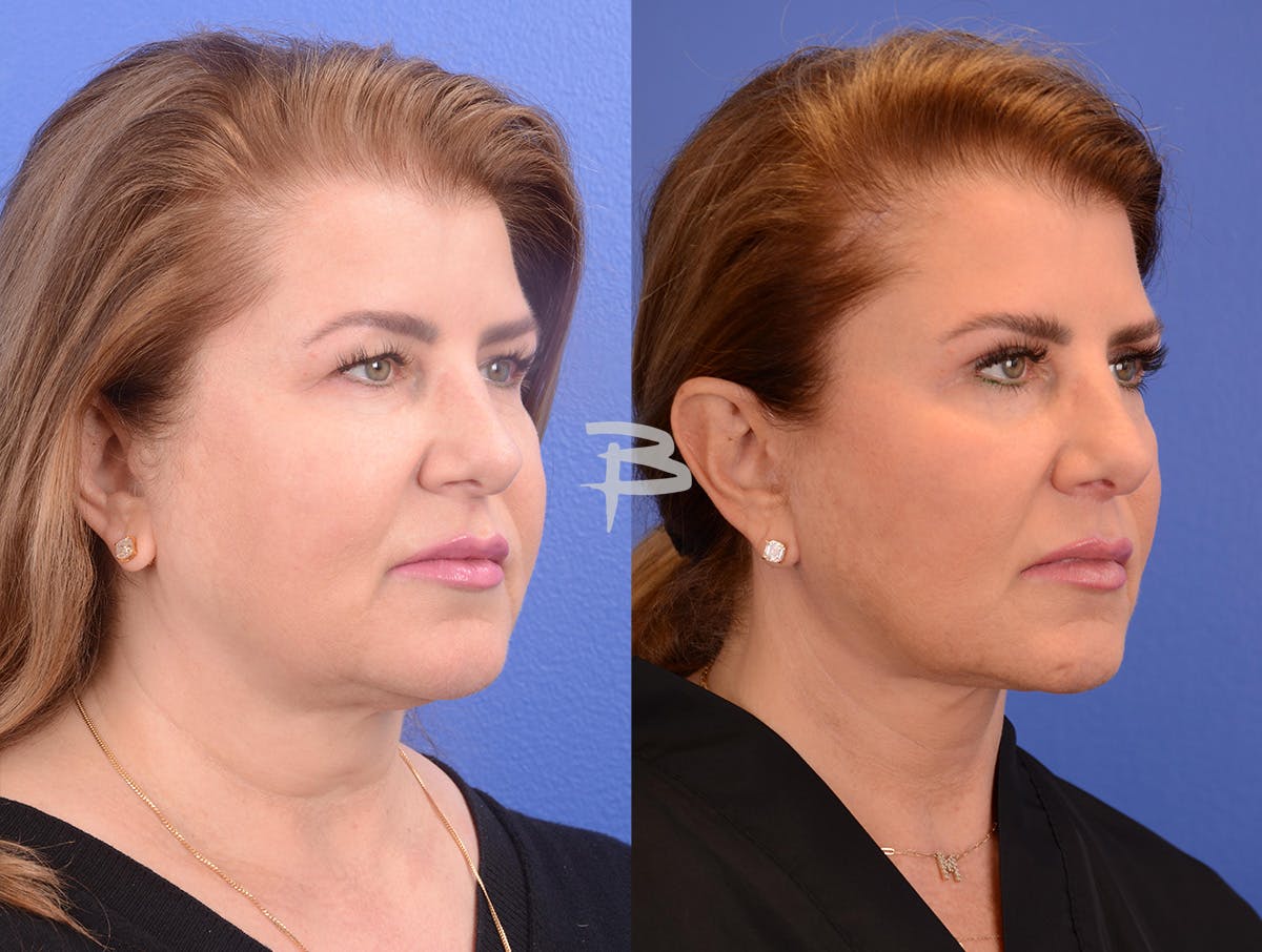 Buccal Fat Removal Before & After Gallery - Patient 202278 - Image 2