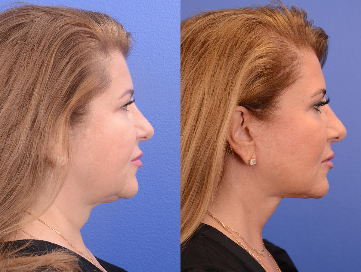 Buccal Fat Removal Before & After Gallery - Patient 202278 - Image 3